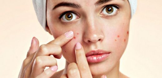 Da mụn có nên dùng kem chống nắng không?