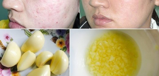 Trị mụn bằng tỏi – phương pháp trị mụn độc lạ nhưng hiệu quả
