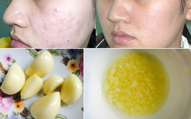 Trị mụn bằng tỏi – phương pháp trị mụn độc lạ nhưng hiệu quả