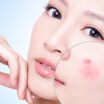 Bí quyết chăm sóc da mụn và thâm, giúp da hết mụn và trắng mịn