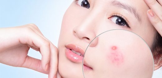 Bí quyết chăm sóc da mụn và thâm, giúp da hết mụn và trắng mịn