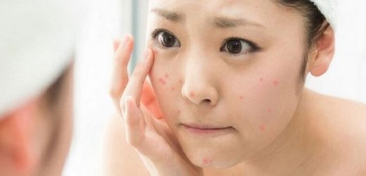 Top 6 serum trị mụn, phục hồi da, dưỡng trắng sáng, ai muốn da đẹp cũng phải có một chai